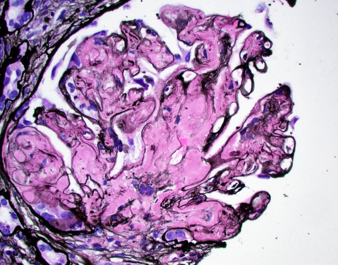 JZRenalPath's tweet image. So much amyloid! This one read the textbook. Negative silver stain. Strong congo red +. Amyloid A IHC positive confirmatory of type AA amyloidosis. #renalpath #nephropath
