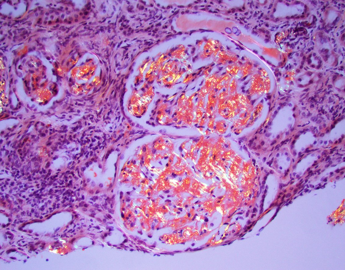 JZRenalPath's tweet image. So much amyloid! This one read the textbook. Negative silver stain. Strong congo red +. Amyloid A IHC positive confirmatory of type AA amyloidosis. #renalpath #nephropath