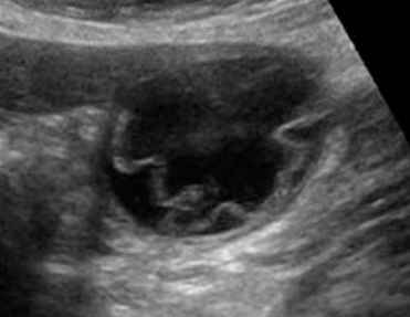 POCUSAcademy's tweet photo. (1/2)
A 38-year-old female presented with pain in the right upper abdomen. The following two images were obtained while scanning her gallbladder. What is the most likely diagnosis?

A. Acute cholecystitis
B. Acute Gangrenous cholecystitis
C. Emphysematous cholecystitis https://t.co/r6ctgFE3wj