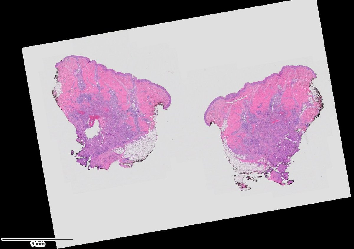 Dermpathl's tweet image. 20s F with evolving nodules mostly on the extremities of several months duration. Organisms were seen with some difficulty with special stains and retrospectively with H&amp;amp;E. Molecular identification by PCR: Blastomyces spp. #dermpath #pathology #IDpath