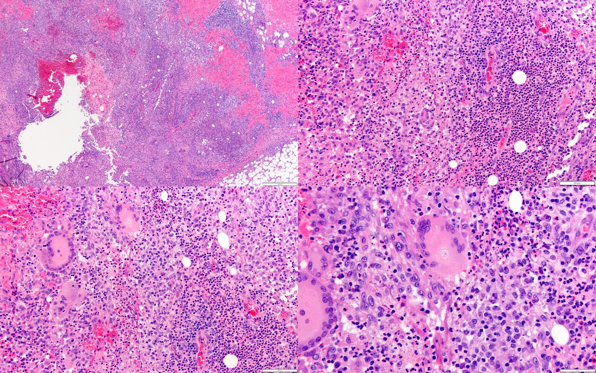 Dermpathl's tweet image. 20s F with evolving nodules mostly on the extremities of several months duration. Organisms were seen with some difficulty with special stains and retrospectively with H&amp;amp;E. Molecular identification by PCR: Blastomyces spp. #dermpath #pathology #IDpath
