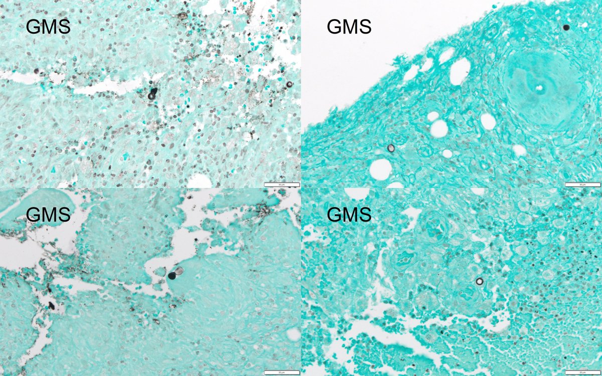 Dermpathl's tweet image. 20s F with evolving nodules mostly on the extremities of several months duration. Organisms were seen with some difficulty with special stains and retrospectively with H&amp;amp;E. Molecular identification by PCR: Blastomyces spp. #dermpath #pathology #IDpath
