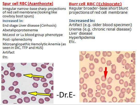 <a href="/NicoGagelmann/">Nico Gagelmann</a> <a href="/BrownJHM/">Journal of Brown Hospital Medicine</a> <a href="/Nischistocyte/">Nishant Rajendra Tiwari</a> <a href="/nihardesai7/">𝗡𝗶𝗵𝗮𝗿 𝗗𝗲𝘀𝗮𝗶 MD, DM</a> @Sthanu5 Echinocytes
Burr cells

Regular broader based short and blunt projections 

Uremia 
Liver disease
Hyperlipidemia 

Should be differentiated from "Spur cells" or Acanthocytes which are irregular narrow based sharp projections