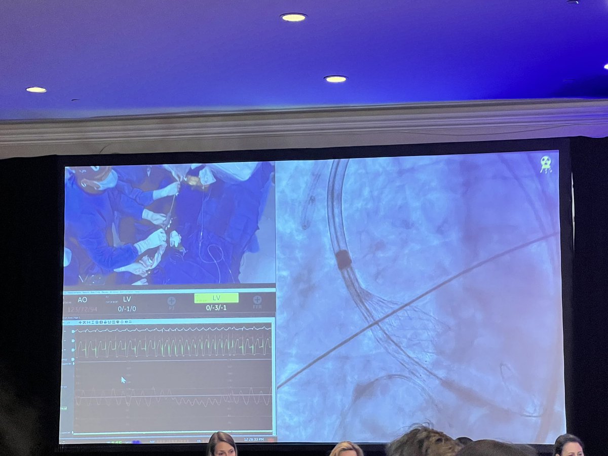 Standing room only at the #crt2023 live stream #TAVR case from @MountSinaiNYC with Dr. Annapoorna Kini and @GilbertTangMD @KHERA_MD Dr. Stamatios Lerakis 👏#ACCWIC @ACCinTouch @WomenAs1