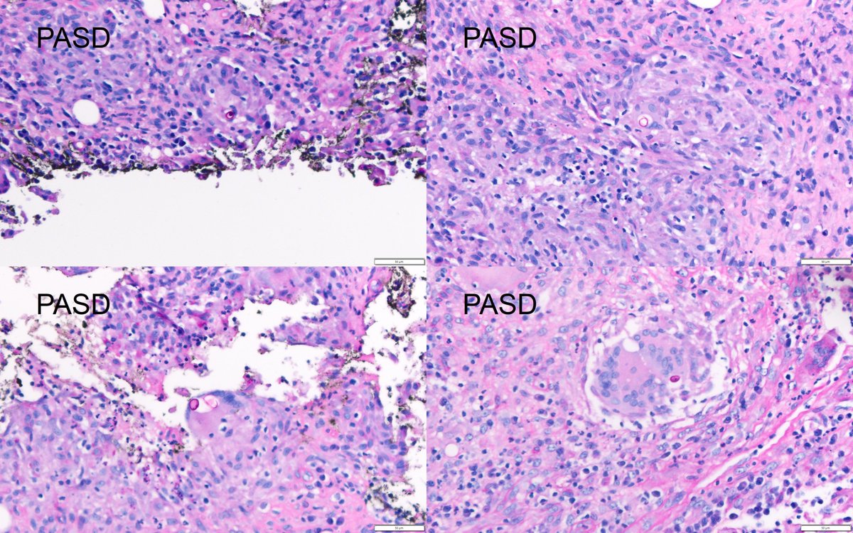 Dermpathl's tweet image. 20s F with evolving nodules mostly on the extremities of several months duration. Organisms were seen with some difficulty with special stains and retrospectively with H&amp;amp;E. Molecular identification by PCR: Blastomyces spp. #dermpath #pathology #IDpath