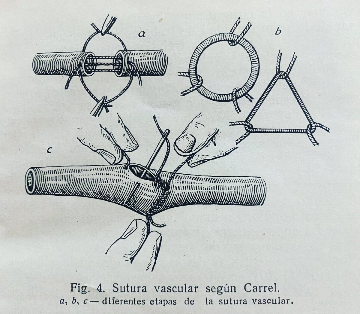 PipeCabreraV's tweet photo. The Carrel vascular anastomosis technique: ideal for small to midsize vessels 🔑🔥🧨! How I do it! #SoMe4Surgery @pferrada1 @Cirbosque @MISIRG1 @SWexner @jmills1955 @monteromiguel @juliomayol https://t.co/dntqkkwKwL