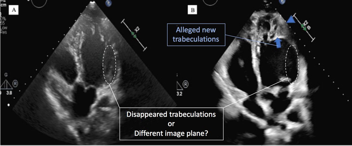 BjarkeJensen4's tweet photo. New paper claiming de novo LV #trabeculation in pregnant woman: https://t.co/KfEc62Ag1H
Two Interpretations possible, however:
1. Trabeculations appear apically (and seemingly disappear at the base)
or
2. Artefact of different image planes.
π€·ββοΈ
#noncompaction #WhyCMR https://t.co/DDAeZq8t6L