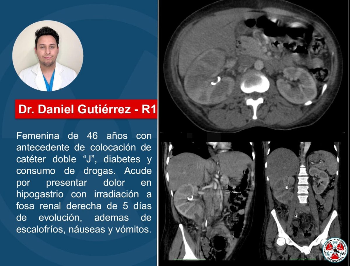Les presentamos el caso semanal, ¿Cuál es tu diagnóstico? #CT #radres #radiology