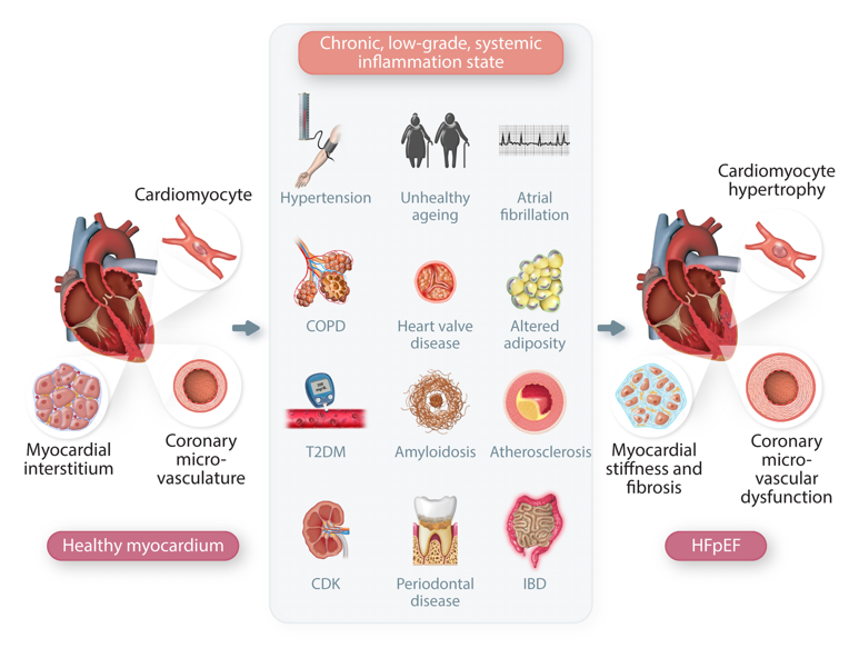 CVR Tomasz Guzik (@cvr_tomaszguzik) on Twitter photo Shining the SPOTLIGHT on #HeartFailure: exploring #inflammatory pathways in #HFpEF
Can we characterize the mechanisms responsible and what are the implications for future trials & novel therapies?
academic.oup.com/cardiovascres/…
<a href="/ESC_Journals/">European Society of Cardiology Journals</a> <a href="/escardio/">European Society of Cardiology</a> #HF #CardiovascularResearch Shining the SPOTLIGHT on #HeartFailure: exploring #inflammatory pathways in #HFpEF
Can we characterize the mechanisms responsible and what are the implications for future trials & novel therapies?
academic.oup.com/cardiovascres/…
<a href="/ESC_Journals/">European Society of Cardiology Journals</a> <a href="/escardio/">European Society of Cardiology</a> #HF #CardiovascularResearch