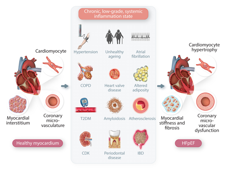 Shining the SPOTLIGHT on #HeartFailure: exploring #inflammatory pathways in #HFpEF Can we characterize the mechanisms responsible and what are the implications for future trials & novel therapies? academic.oup.com/cardiovascres/… @ESC_Journals @escardio #HF #CardiovascularResearch