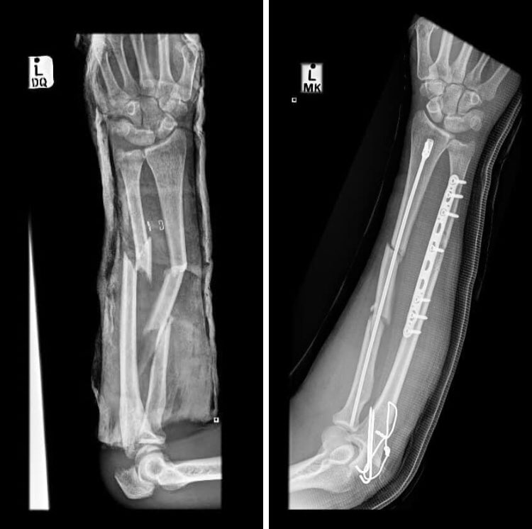 Anterior augmentation plating of aseptic humeral shaft nonunions after  intramedullary nailing | Archives of Orthopaedic and Trauma Surgery