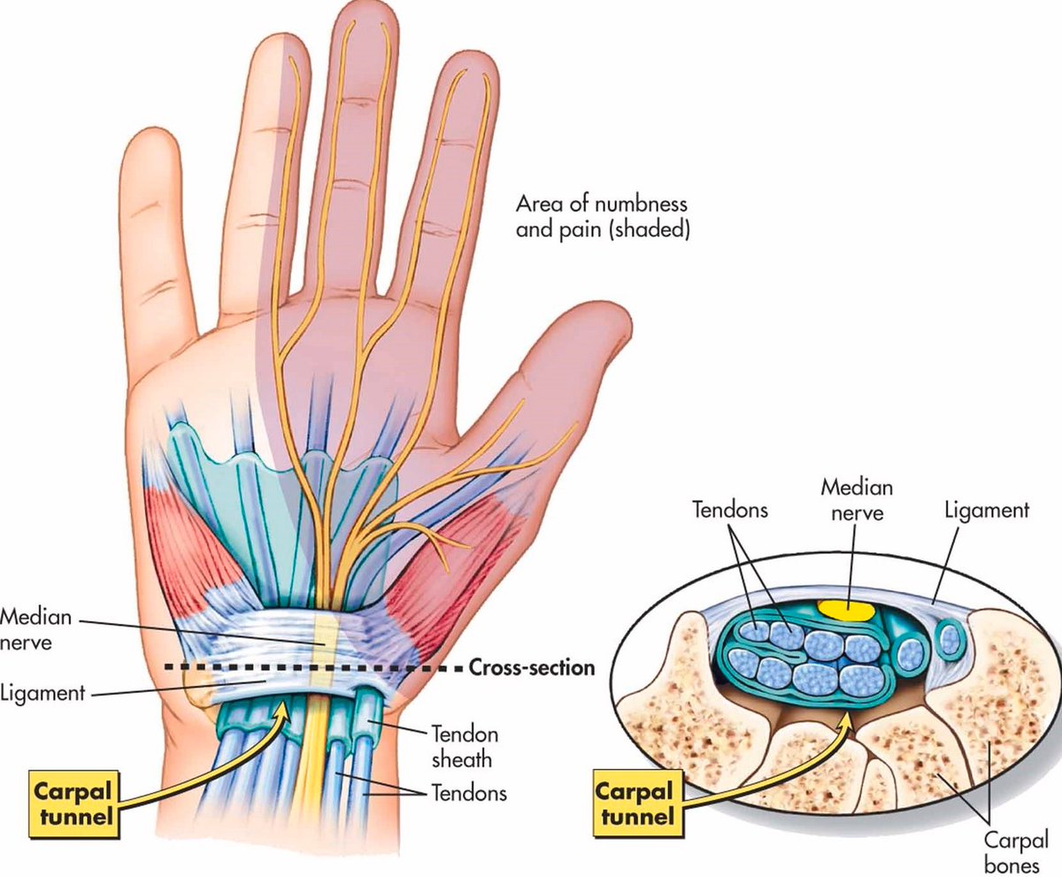 Studying Medicine on Twitter "Carpal tunnel syndrome median n