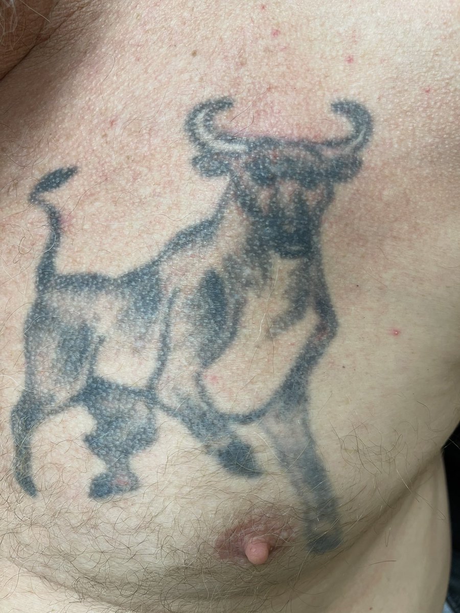 cyrus_rhythm's tweet photo. @AMussigbrodtMD @EPeeps_Bot Posted with permission from patients. Scar in the brim of the hat and in between the bull horns. SCICD and DCPPM respectively. https://t.co/HKRsc2ArR2