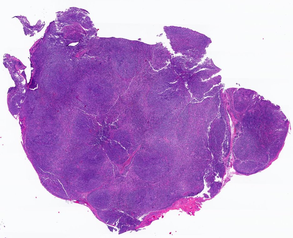 SibaElHussein's tweet photo. Drug Reaction With Eosinophilia and Systemic Symptoms Syndrome (DRESS) involvig LN with AITL-like morphology:

🩸Dense infiltrate of polymorphic lymphocytes  
🩸Preserved overall architecture: Adequate B &amp; T-cell compartments (sign of benignancy)

#hemepath #lymsm #pathtwitter https://t.co/05dKKX2lgH