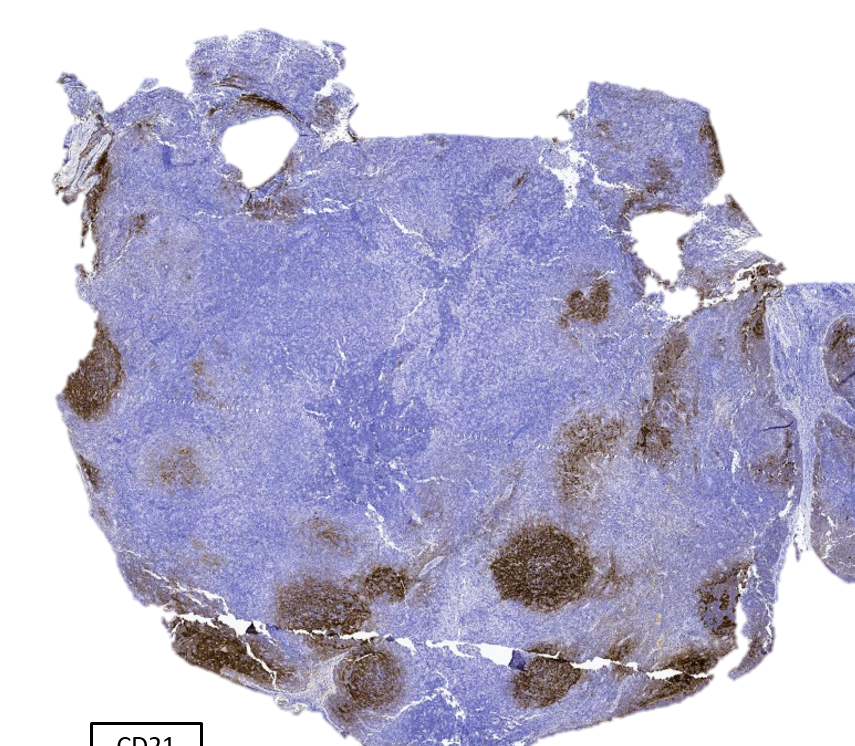 SibaElHussein's tweet photo. Drug Reaction With Eosinophilia and Systemic Symptoms Syndrome (DRESS) involvig LN with AITL-like morphology:

🩸Dense infiltrate of polymorphic lymphocytes  
🩸Preserved overall architecture: Adequate B &amp; T-cell compartments (sign of benignancy)

#hemepath #lymsm #pathtwitter https://t.co/05dKKX2lgH