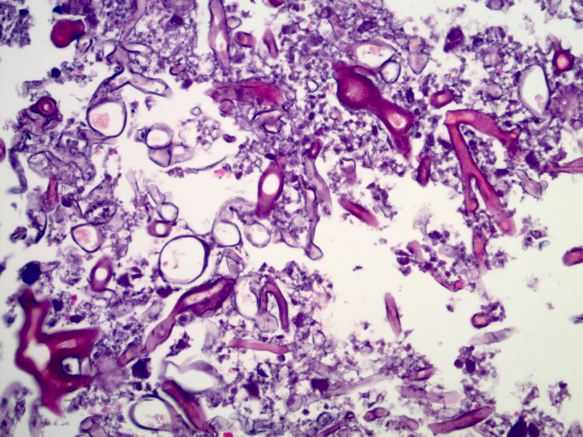 smlungpathguy's tweet photo. Pulmonary mucormycosis:  https://t.co/2eQa3bSi1Q https://t.co/o6sbywjfGt