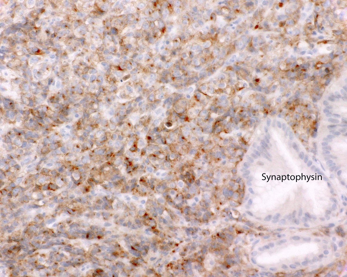 Small cell carcinoma of the esophagus associated with Barrett mucosa. Note the dot-like Synaptophysin expression.#CaseoftheWeek #PathTwitter