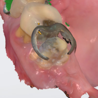 A crown under a partial USED TO BE a complicated procedure.  Digital can make it very simple.

More convenient AND a better result - that's progress.