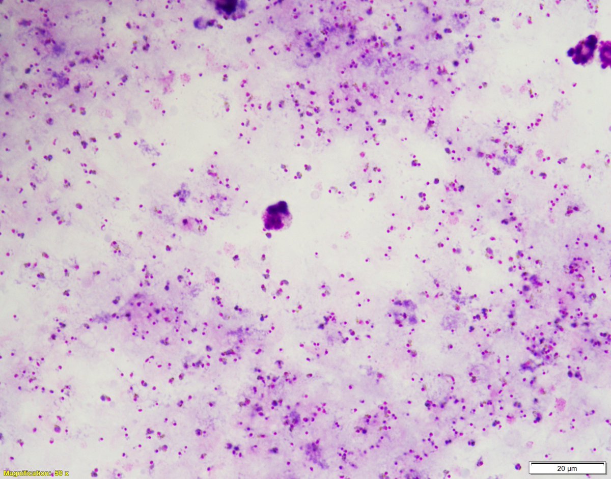 ParasiteGal's tweet image. This week’s impressive case is donated by Dr. Ryan Relich: parasitewonders.blogspot.com/2023/02/case-o… Diagnosis?  Answer later this week! #mayopath #pathology #IDPath #CrittersOnTwitter #PathBugs
