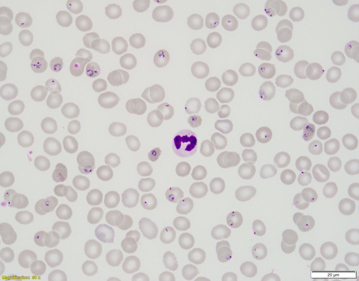 ParasiteGal's tweet image. This week’s impressive case is donated by Dr. Ryan Relich: parasitewonders.blogspot.com/2023/02/case-o… Diagnosis?  Answer later this week! #mayopath #pathology #IDPath #CrittersOnTwitter #PathBugs