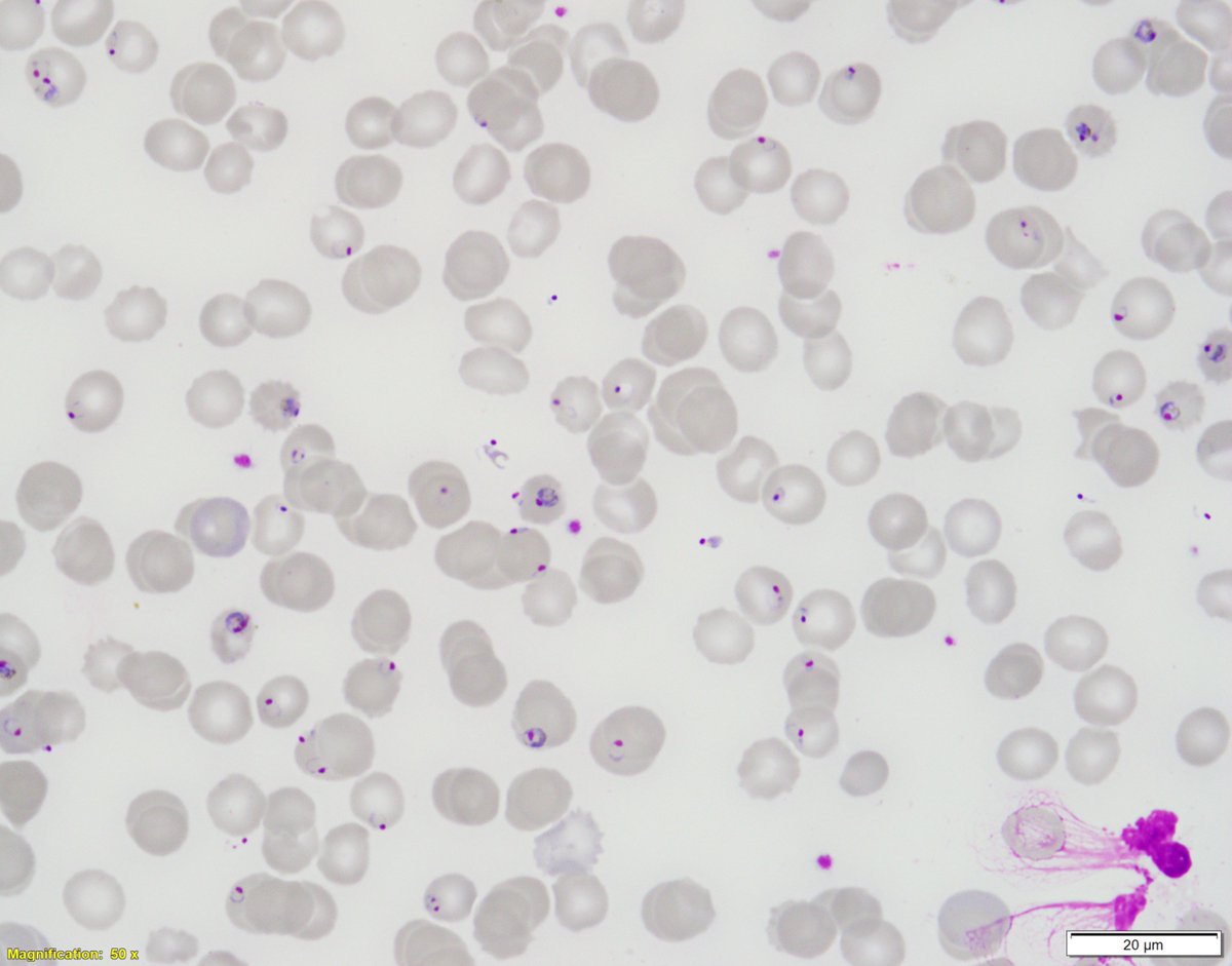 ParasiteGal's tweet image. This week’s impressive case is donated by Dr. Ryan Relich: parasitewonders.blogspot.com/2023/02/case-o… Diagnosis?  Answer later this week! #mayopath #pathology #IDPath #CrittersOnTwitter #PathBugs