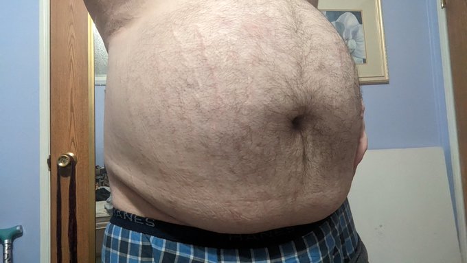 Saline belly. This is the morning aftermath of a 1 litre D5NS infusion. Just one litre! I need a way