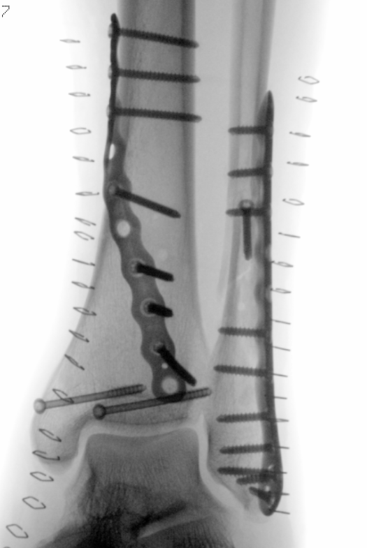 traumaticum's tweet photo. long day, but this spiral plate has left me smiling. ive had twirly plate envy since @Drlyndonmason posted some cool Volition @Ortho_Solutions plates so needed to try and make my own for this huge type C posterior mal. syndemosis gap bugs me, postop ct inbound. #orthotwitter https://t.co/HVmSWjR1Fr