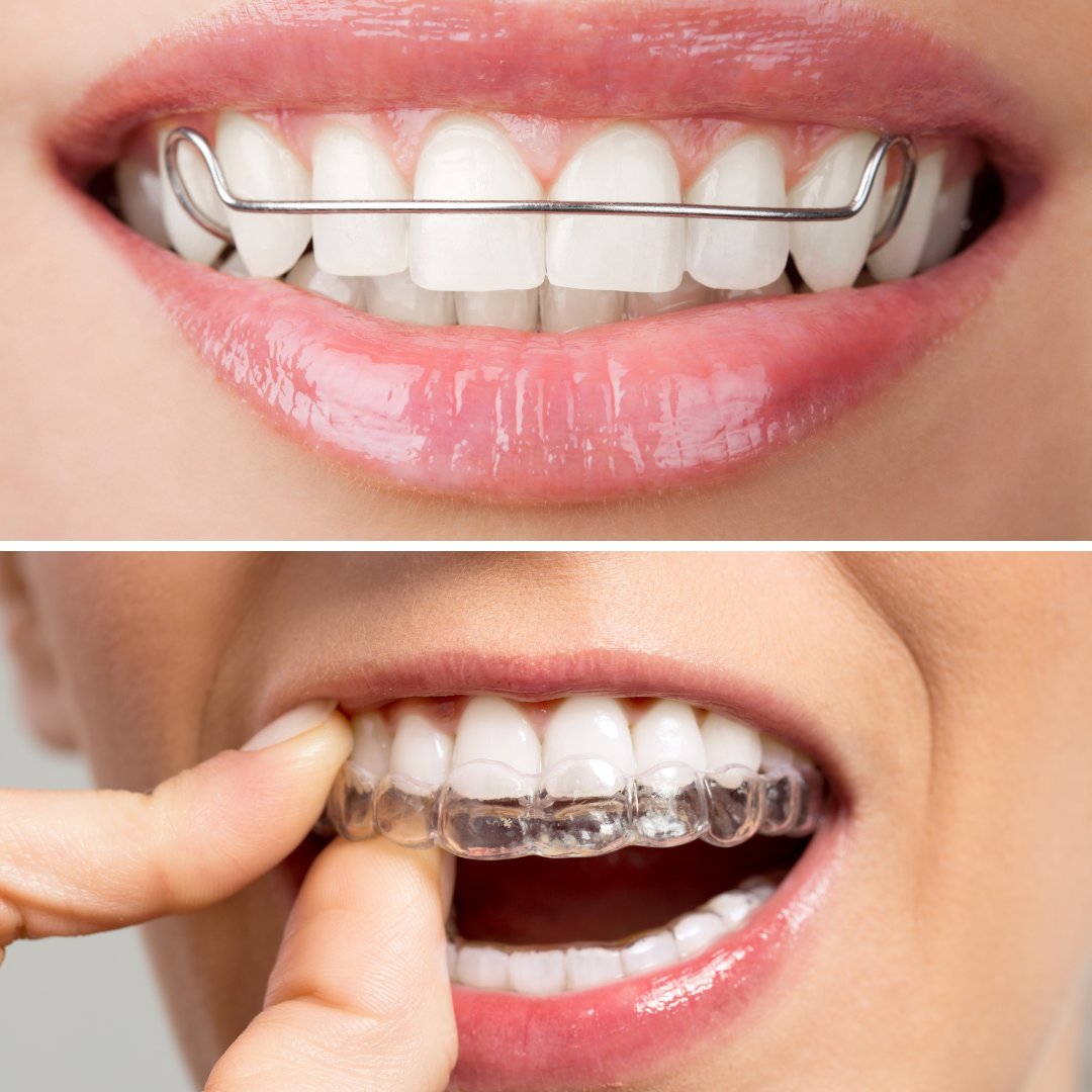 Make sure to clean your retainers thoroughly once a day to avoid any germs from building up! Simply soak your retainer in retainer cleaner as per package instructions OR a mixture of equal parts of hydrogen peroxide and water for 30 minutes.