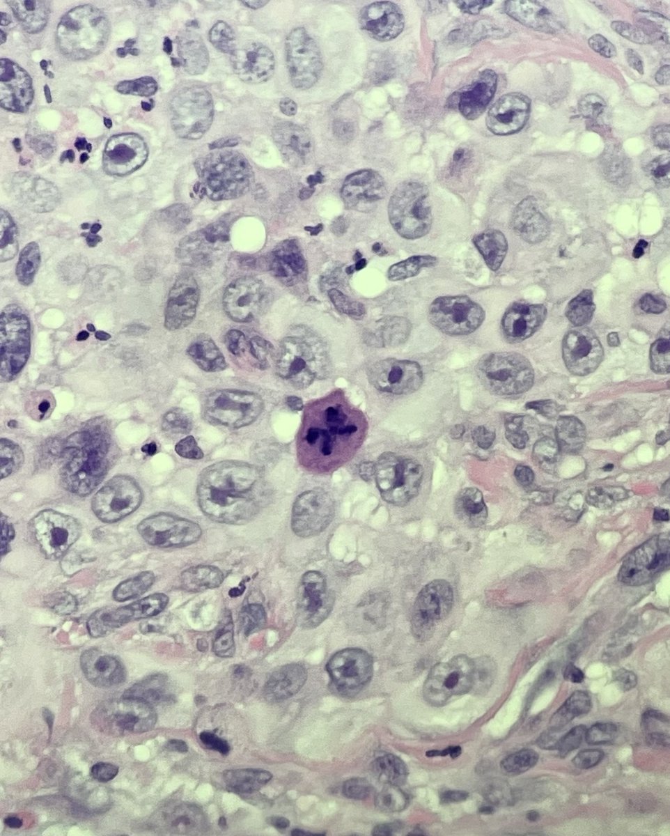 AbbiePath's tweet photo. X marks the spot! #cellpath #pathology #histopathology #dermatopathology #dermpath #iloveagoodmitosis https://t.co/rXZMoGTRL7