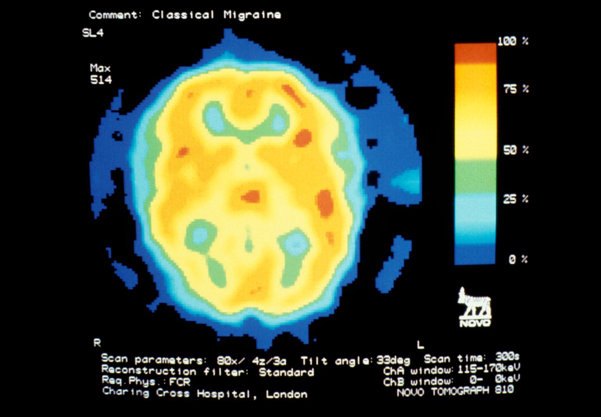 Independent Nurse (@indynursemag) on Twitter photo Why are migraines three times more common in women than in men? <a href="/rebecca_stuckey/">rebecca stuckey</a> on the hormonal connection to headache. independentnurse.co.uk/clinical-artic… Why are migraines three times more common in women than in men? <a href="/rebecca_stuckey/">rebecca stuckey</a> on the hormonal connection to headache. independentnurse.co.uk/clinical-artic…