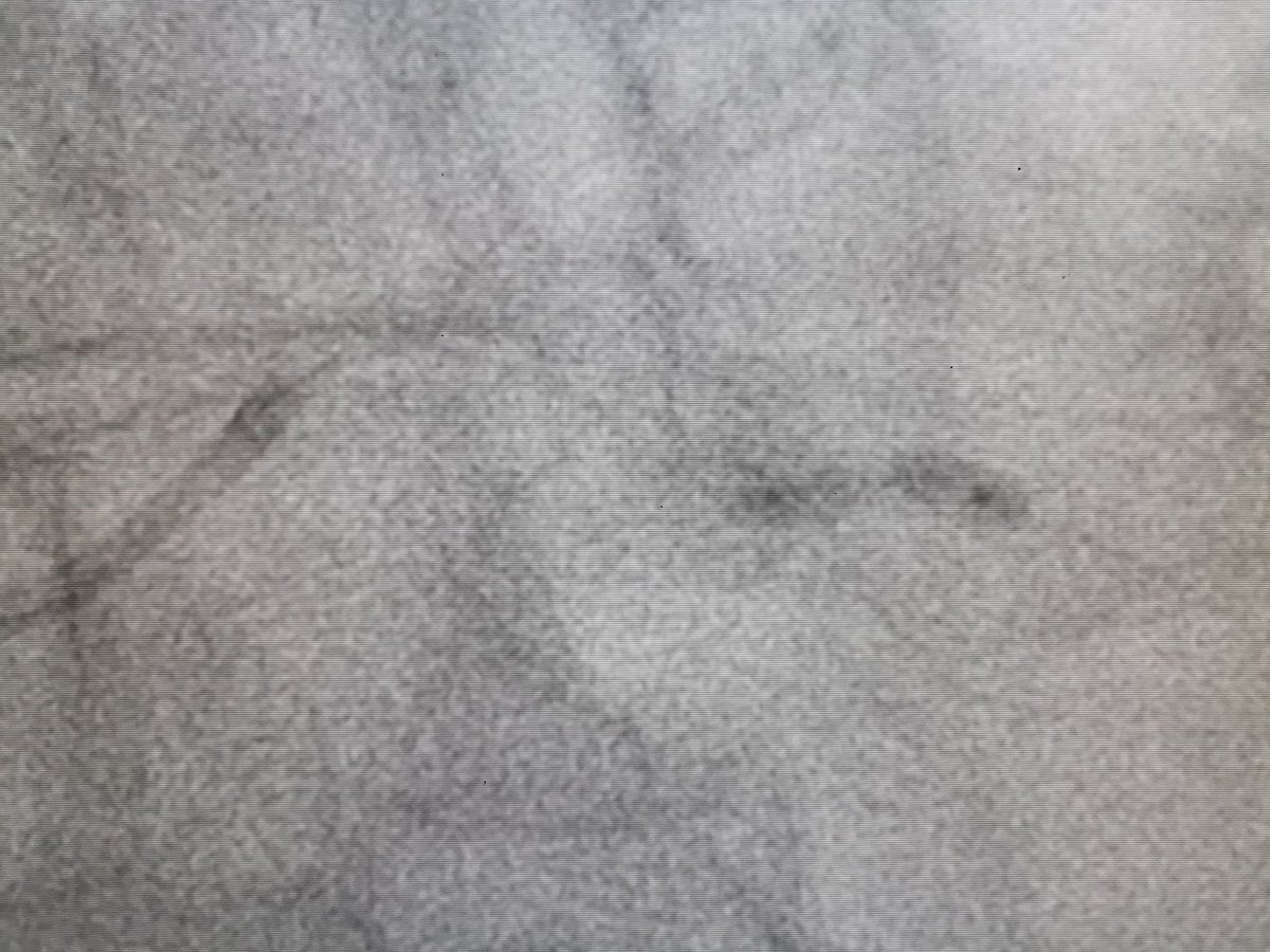 MarekRadomski71's tweet photo. #ROTA #CHIPPCI #PCI 74 yo male with 3 VD and heavy calcification. PCI Cx-OM 1st attempt failed (2,75mm NC balloon 22 atm) IVL was suggested. 2nd attempt 7F GC, #rotablation 1,75mm burr, stent 2,5x26mm postdilated 3,0 NC balloon 24-26atm Good result (if not IVL is next step) https://t.co/n9JzjJQ5mV