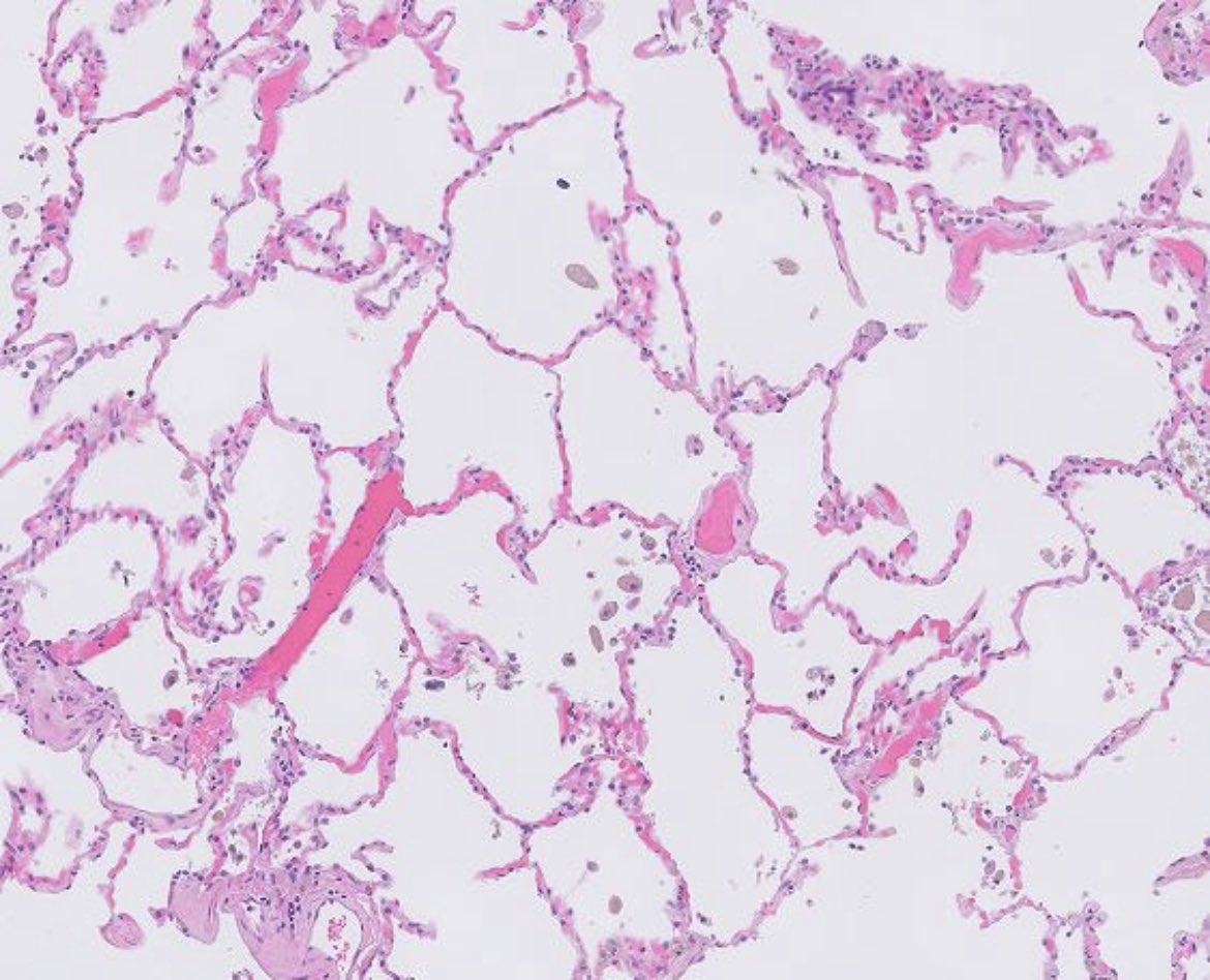OhioStatePath's tweet photo. Great thoughts everyone!
We were referring to Lung.
Fun facts:
MC tumor metastasizing to brain- Lung ca
MC site for cancers to metastasize- Lung
#pathtwitter #pulmpath #Pathresidents #PathNewbies https://t.co/t1PDNshjsq