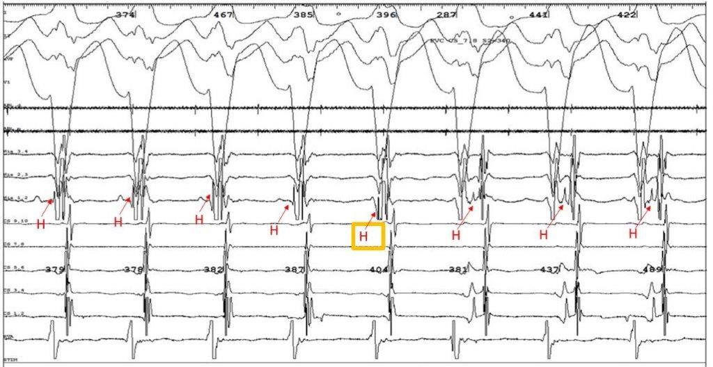 EhdaieMd's tweet photo. Answer: AVRT
This 💎 is antidromic atriofascicular “mahiam” tachy. Watch the His👇
1- HV -20ms
2- V-H decrement beat 5 prolongs CL w fixed H-A
3- V-H longer = longer CL = HPS is part of circuit…..think “reverse Coumels” 😎#Epeeps #Epfellows #BeautifulEP https://t.co/ribUvzfH4g