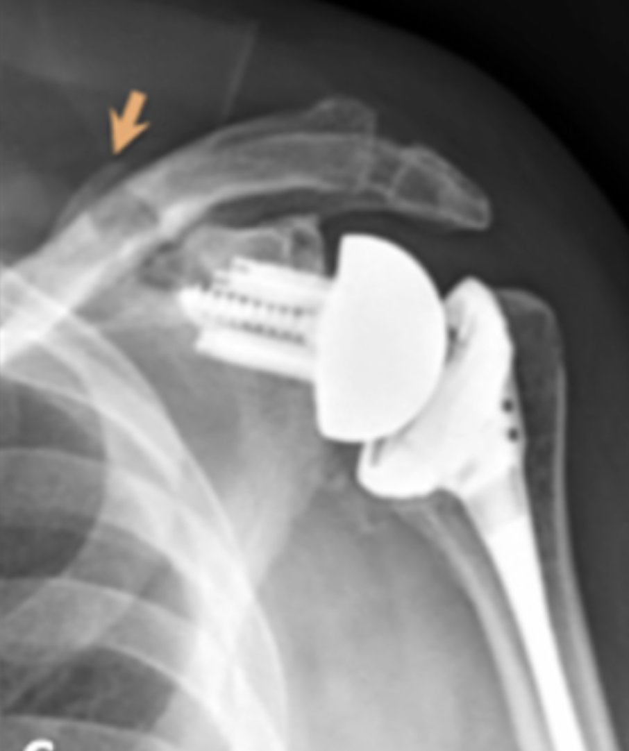 Acromial and spine fractures complicating reverse total shoulder arthroplasty. shoulderarthritis.blogspot.com/2023/02/acromi…
