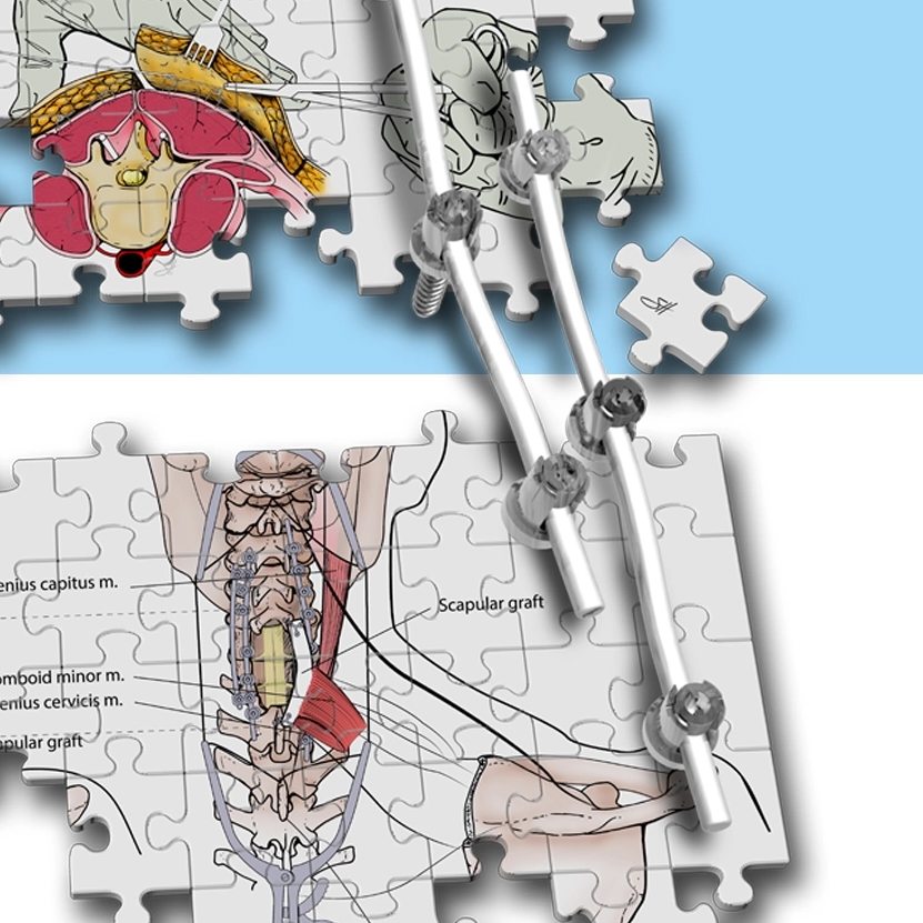 Excited to be on my first text book cover!
For this new sub-specialty Spino-Plastic Reconstruction.
Teaser image of detail. <a href="/WinocourMD/">Sebastian Winocour, MD, MBA, FACS</a> <a href="/BCMNeurosurgery/">BCM Neurosurgery</a>  <a href="/dredwardreece/">Edward Reece</a> <a href="/DrRosengart/">Todd Rosengart, MD</a> <a href="/BCM_Surgery/">BCM_Surgery</a>