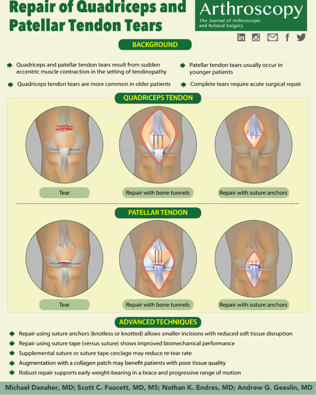 🛠️ February Infographic🦿:
Repair of Quadriceps and Patellar Tendon Tears
#orthopedics #surgery #sportsmedicine 
Scott Faucett MD, MS

ow.ly/nfPk50MWrI3