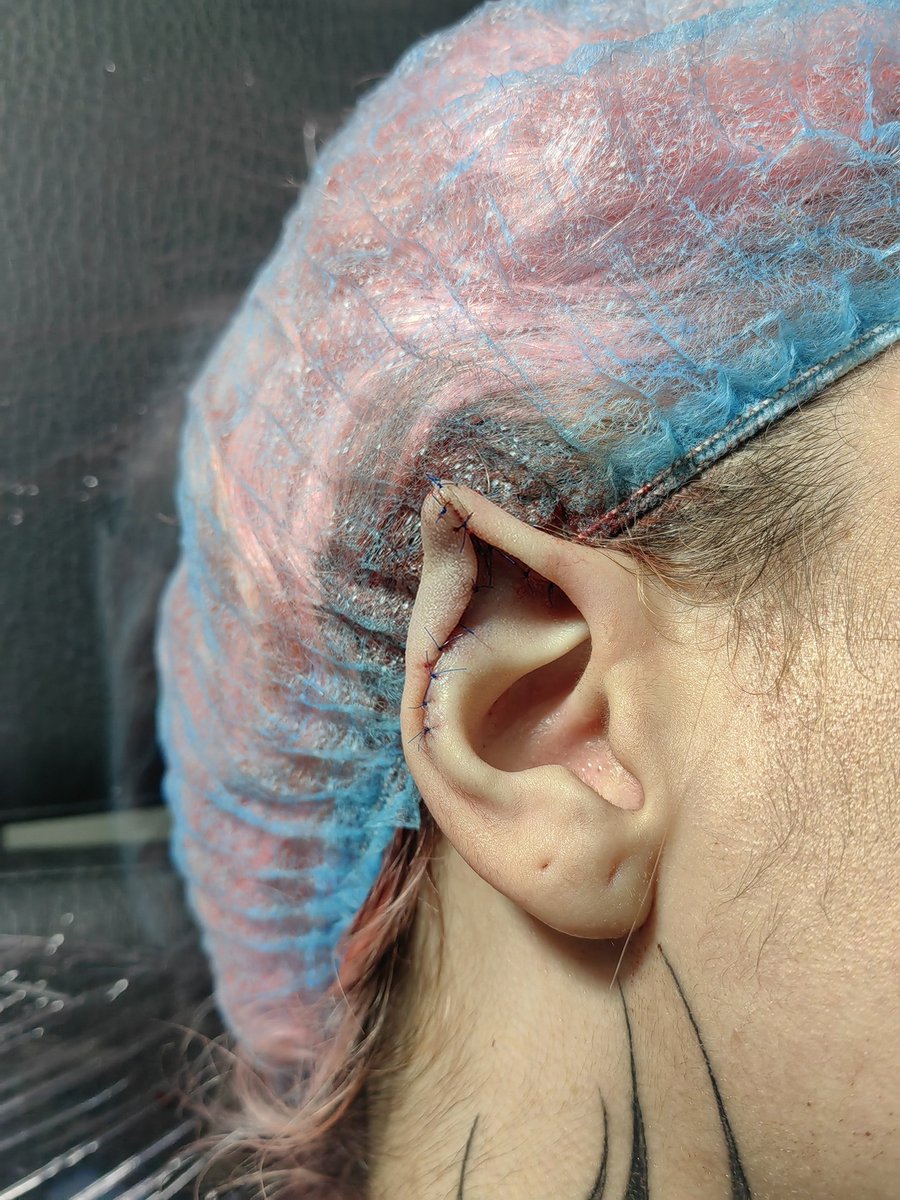 JuanseTabares_'s tweet image. Les comparto el último trabajo que hago aquí en Medellín, un #earpointing o más conocido como erejitas de elfo.