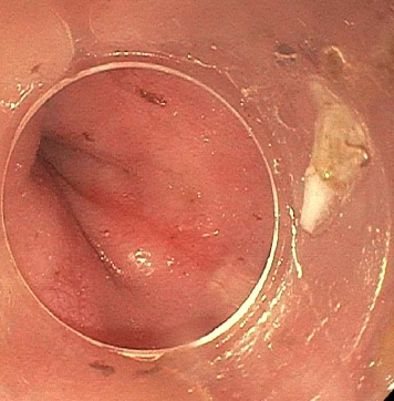 Another 2AM 🕝 #FoodImpaction

Another victory for the clear cap! 🧢

These cases can be frustrating and take hours - conventional endoscopic tools do not always work well.  A brief 🧵 on cap-assisted management of impactions.

#GITwitter #MedTwitter #esophagus #esocrew

1/