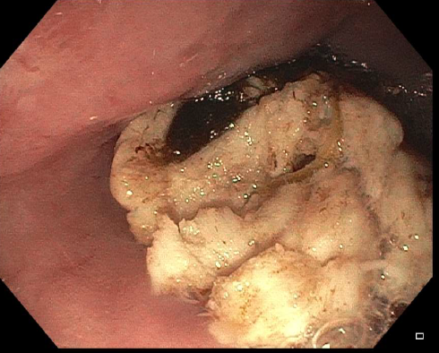 JamesHaddadMD's tweet photo. Another 2AM 🕝 #FoodImpaction

Another victory for the clear cap! 🧢

These cases can be frustrating and take hours - conventional endoscopic tools do not always work well.  A brief 🧵 on cap-assisted management of impactions.

#GITwitter #MedTwitter #esophagus #esocrew

1/ https://t.co/KoK88gJGDG