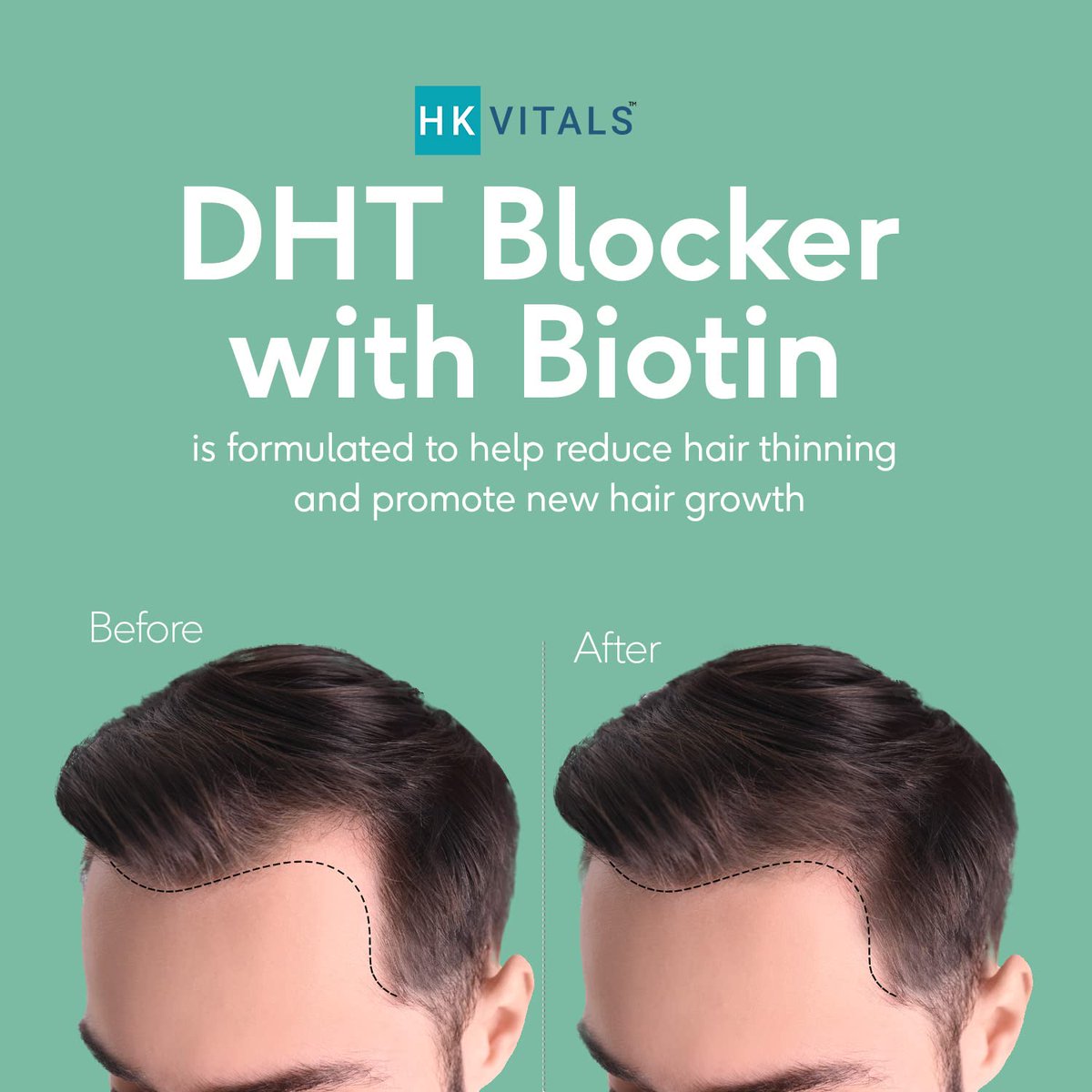 MindYourDeal's tweet photo. Rs 424 at 25% + Rs 25 coupon discount on HK Vitals DHT Blocker with Biotin, Helps Reduce Hair Fall
Amazon Deal (affiliate)- https://t.co/3GrfxV2lRy
#healthkart #hkvitals #hairfall #hairstyle #men #dhtblocker #biotin #multivitamin #omega3 #health #nutrition #fitness #personality https://t.co/79Kj7mVdrb