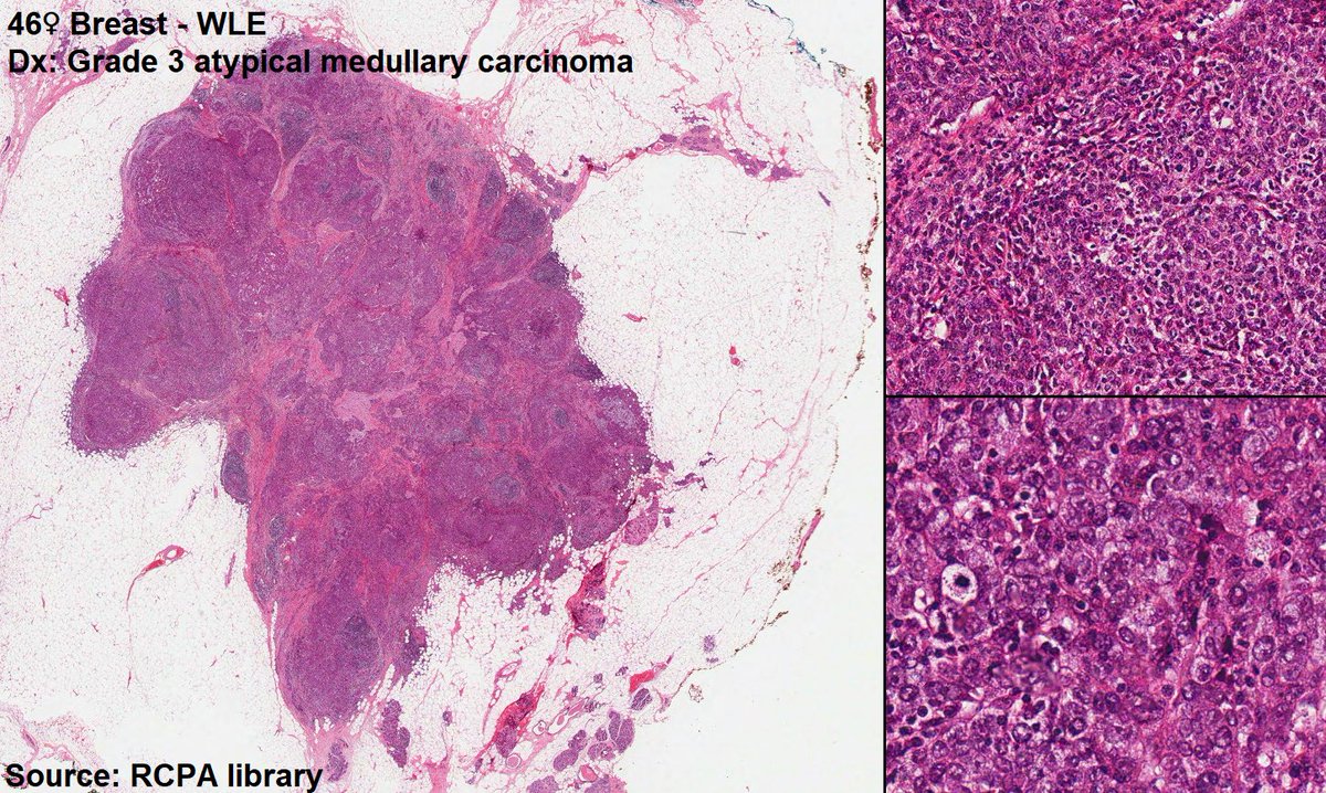 ThisMedicalLife's tweet photo. Episode 31 BRCA (cont)

We continue our discussion about the BReast CAncer (BRCA) genes

This episode includes special guests:
-Prof Nick Murray (Medical Oncology)
-Dr Eryn Dow (Med Onc/Clinical Cancer Genetist)

Histology (below): Breast Cancer of a patient BRCA +ve
#MedTwitter https://t.co/tperVlfYey