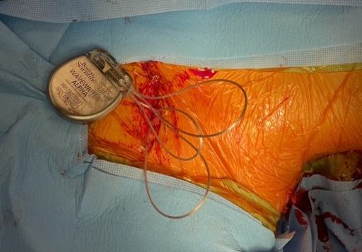 Sometimes you have to get creative with #neuromodulation for #facialpain. Here I combined high cervical #SCS with supraorbital/trigeminal #PNS and occipital nerve stimulation.

SCS first with high thoracic access and lead tunneled to shoulder. Flip supine for the remainder.