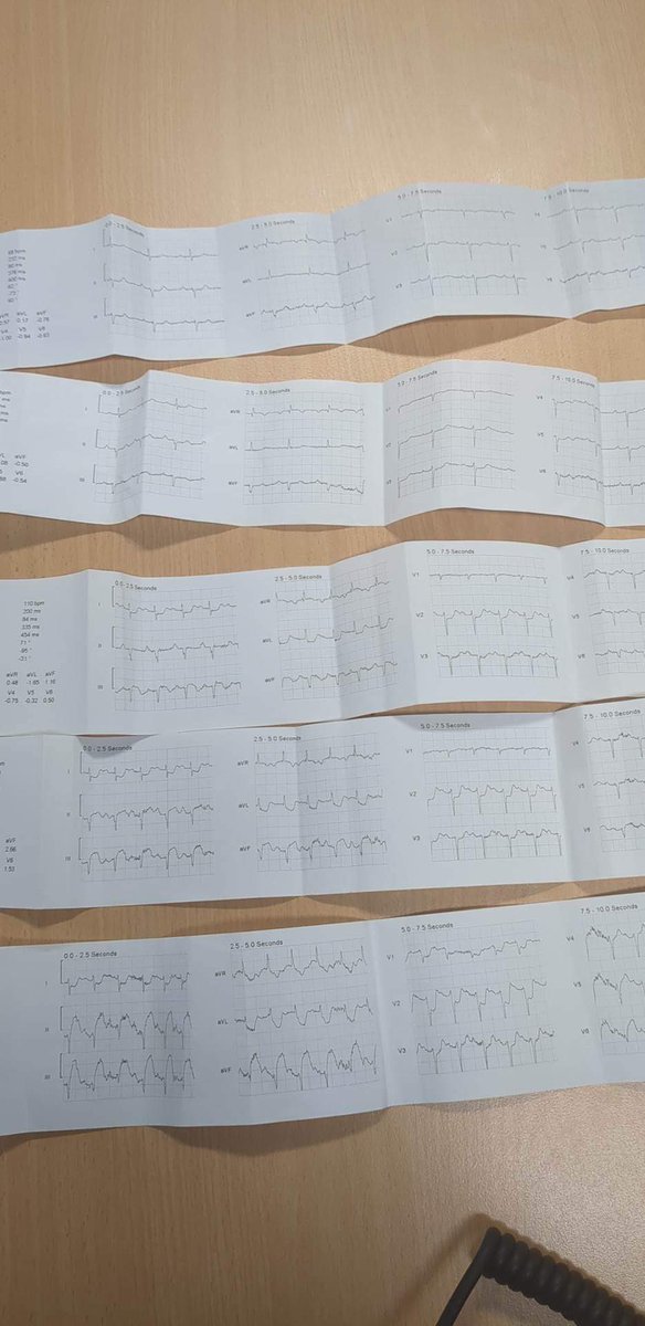 CurtHamid's tweet photo. @rosesusitation Very topical. The fellas on day shift did this last week. Critically unwell anaphylaxis with unrecordable BP and near complete airway obstruction.  STEMI pattern resolved with robust anaphylaxis management, maybe just spasm and the ultimate stress test. Thanks for sharing https://t.co/hPGwfl4Nno