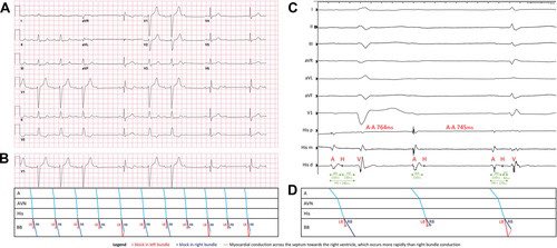 JGrapsa's tweet image. #ECGchallenge #JACCCaseReports @JACCJournals What is noted on the ECG?
Check poll below ⬇️ @Dr_Santangeli @JonChrispinMD @DrAJRestrepo @jacabreracardio @Dr_Nazarian_EP @AatishGarg_EP @ImperialEP @pcw_EP