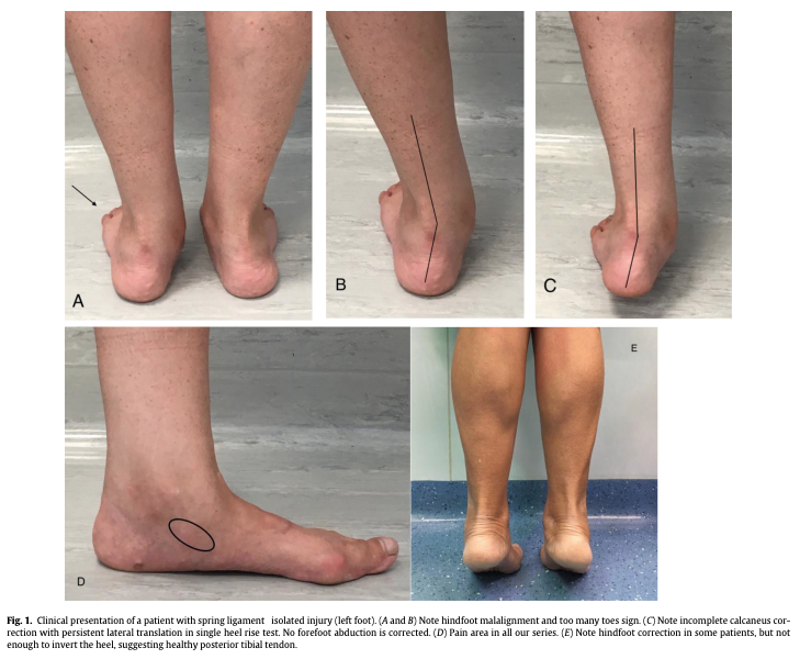 Flawless_Physio's tweet photo. We often consider Posterior Tibial Tendon Dysfunction (PTTD) as the primary cause of Adult Acquired flat foot deformity.  

However, how much consideration should we give to the Spring Ligament? 🧵 1/5 https://t.co/ORCdFLsMS5