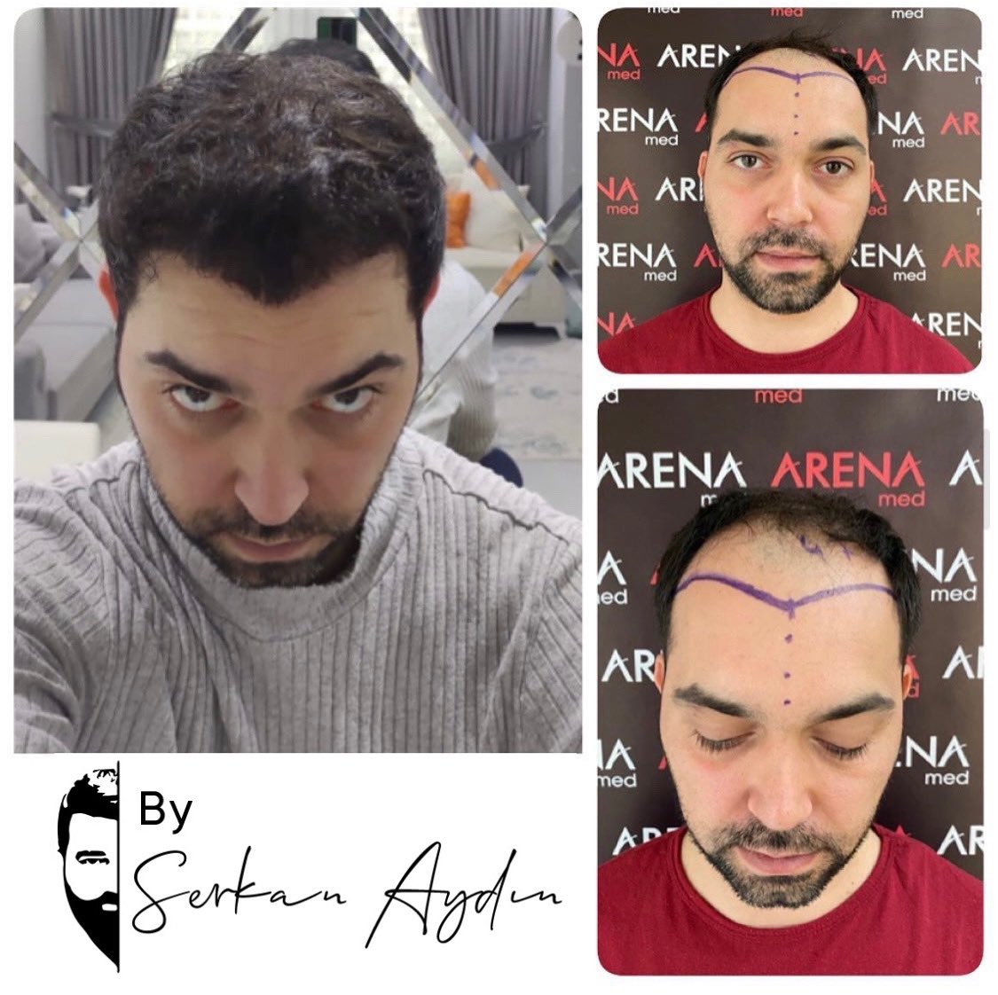 Arenamedd's tweet photo. #serkanaydin #arenamed #saçlıseferleri #hayallerdökülmez #srk #hayallerdökülmezsrk #hayallerdökülmezserkanaydın
#saçaatılanimzaserkanaydın #thesignatureonhairserkanaydın #saçaatılanimza #thesignatureonhair #srkline 🧿👍 https://t.co/oyfJ8qSx3C