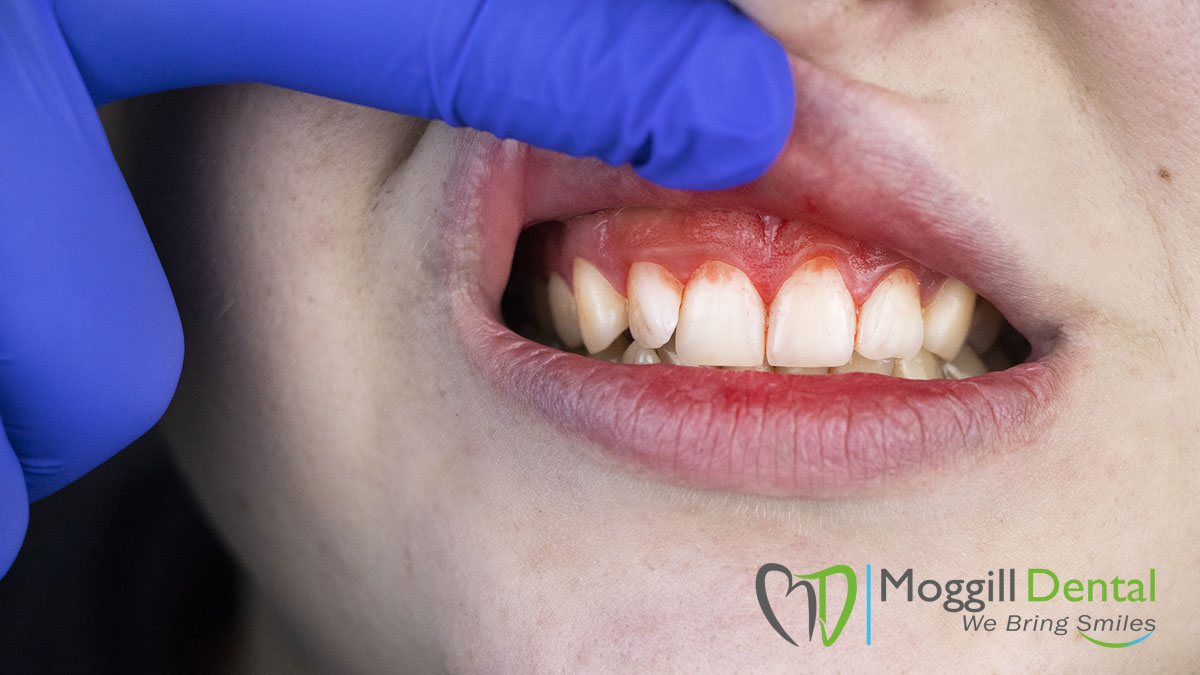 Bleeding gums can be a sign of gum disease, which is caused by a build-up of plaque on the teeth. 
#loveyourteeth #smiles  #smilesforlife #healthysmiles #dental #dentist #moggill #australia