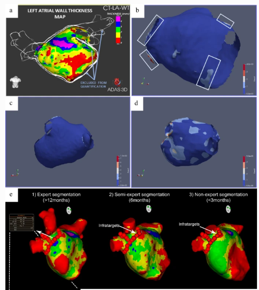 JICE_EP's tweet photo. 🚨Latest #FreeRead Article in
@JICE_EP
Reproducibility Analysis of the CT Angiography–Derived LA Wall Thickness Maps
A Valles-Colomer, BR Forcada, @Davidsotoiglesi, @DrCherylTeresEP @diegopenela1 @DrBerruezo & RM Figueras i Ventura
📖🧐: https://t.co/9So1ikK5Mw
#EPeeps https://t.co/Gw7uiB4bJz