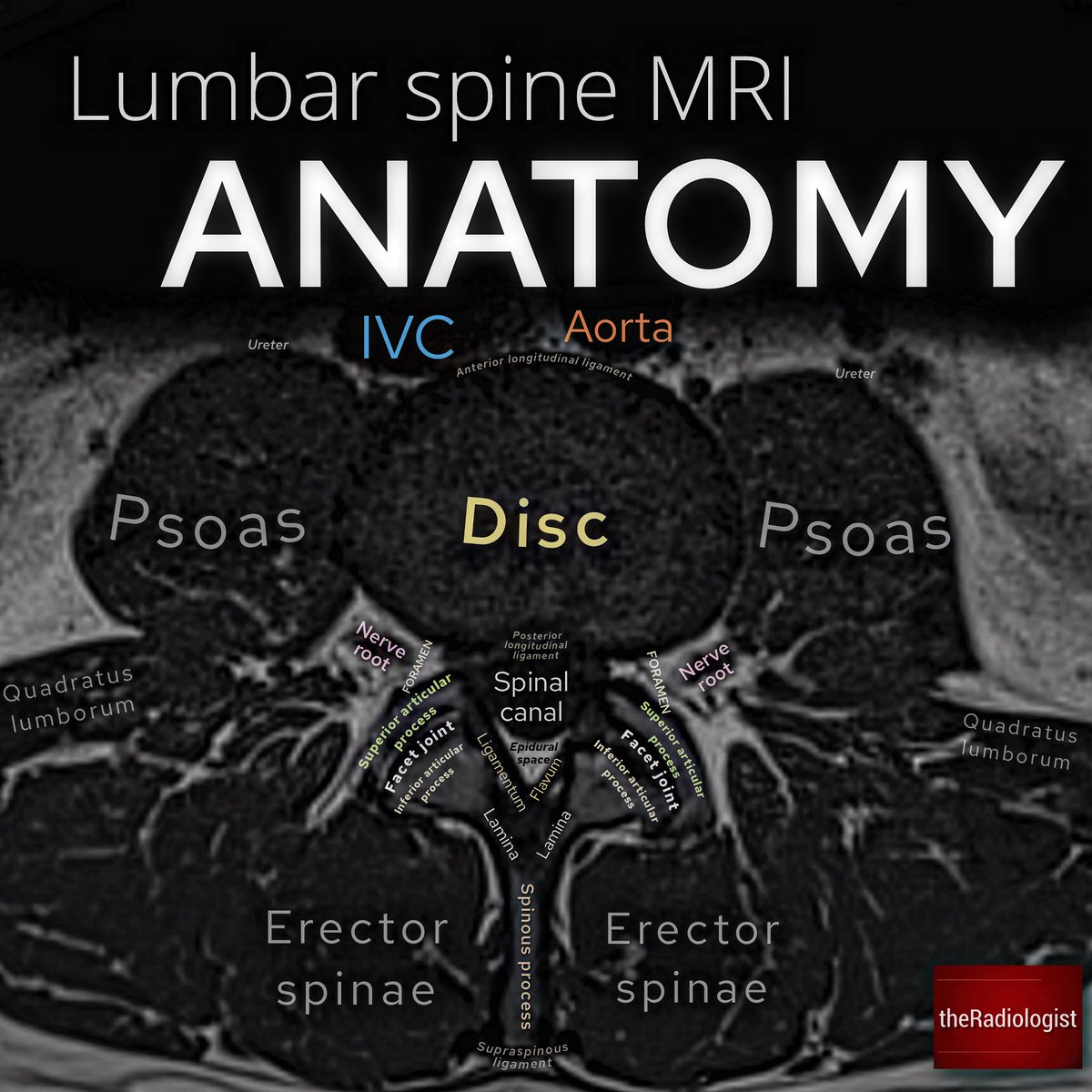 radiologistpage's tweet photo. Lumbar spine MRI nomenclature and anatomy https://t.co/Si4KaRYRjK