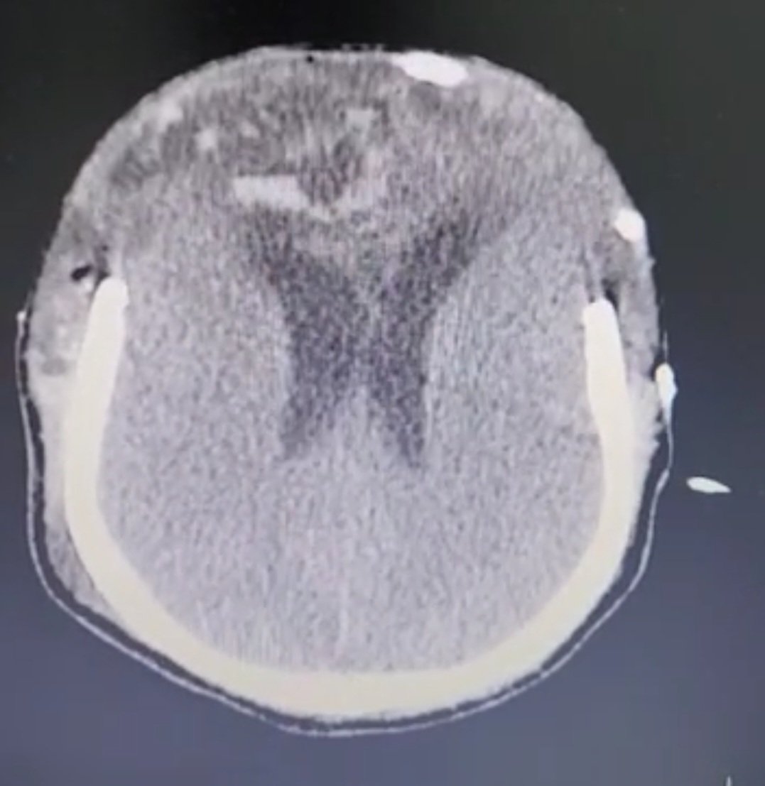 jmjaureguiMD's tweet photo. 38 años, TCE grave, aprovechando la ventana que produce la craniectomia bifrontal se obtiene una vision completa del poligono de Willis descrito por Thomas Willis en 1664. Se usó un trasnductor convexo. @neurointensivos @NeuroPocus @BolonaMD @DannySilvaC1 @JohnPeaMoran1 https://t.co/XXAyVyLZQW
